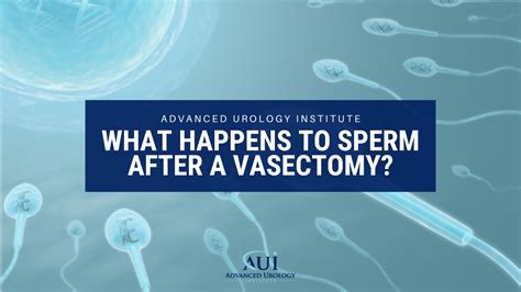 I just said <strong>sperm</strong> going into my tissues. . Sperm granuloma 2 years after vasectomy